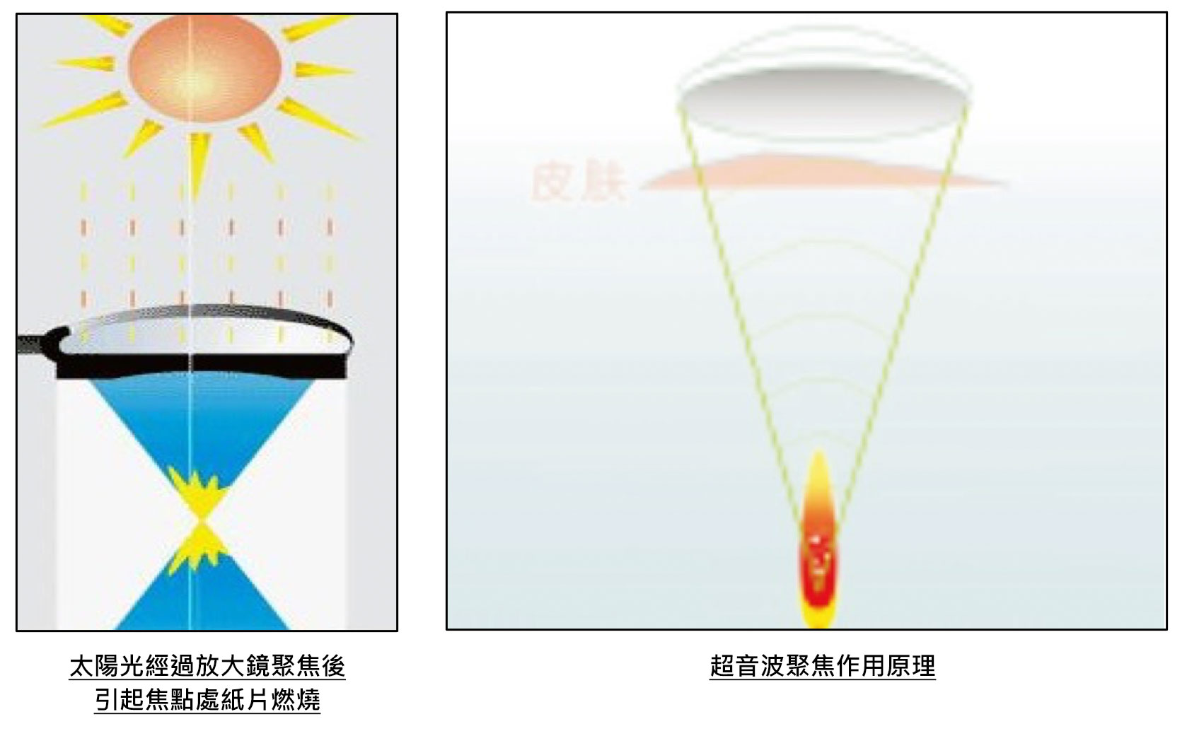 海芙聚焦超音波無創治療